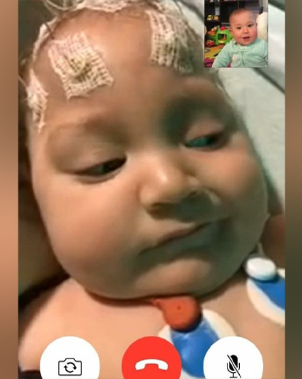 Infantile Spasms Part 2