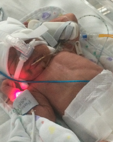 Premature Babies Aren’t Cute